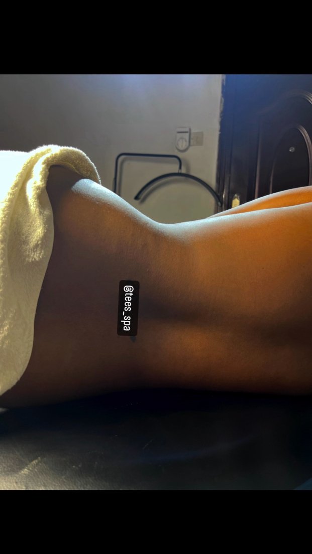 Waist Line Reduction