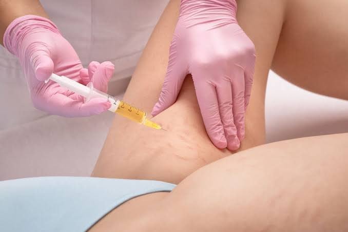 6 Sessions on PRP Stretch Mark Removal
